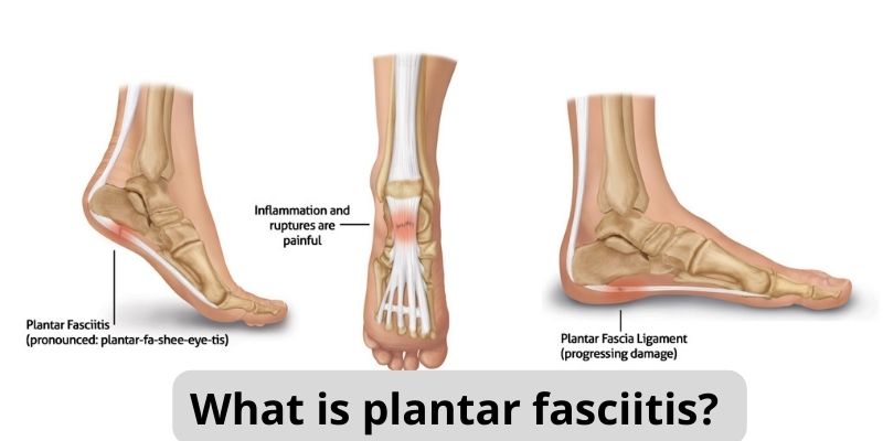 What is plantar fasciitis